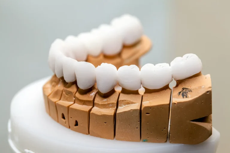 Brug op implantaten op een model